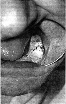 Передпухлинні захворювання слизової оболонки порожнини рота