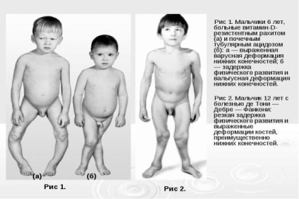 Синдром де тони-Дебре-Фанконі у дітей, жінок і чоловіків причини, симптоми, діагностика, лікування