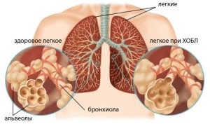 Хронічна обструктивна хвороба легень
