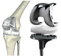 Ендопротези колінного суглоба