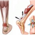 Внутрісуглобні переломи колінного суглоба