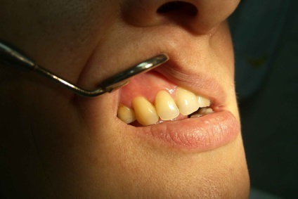 Зуби руйнуються в ясен що робити