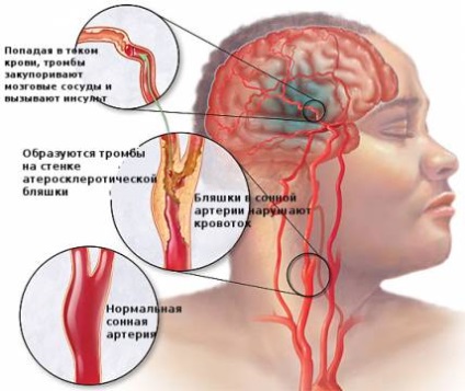 Атеросклероз судин головного мозку - причини, симптоми і лікування