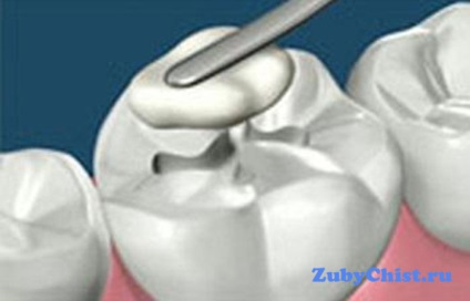 Що робити якщо покришилася тимчасова пломба поради стоматолога