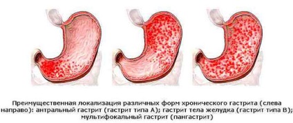Лікування гастриту, де лікувати гастрит у Санкт-Петербурзі