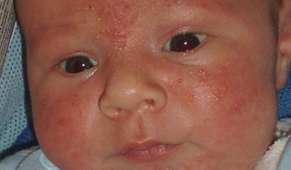 Алергія у дітей особливості, характерна симптоматика