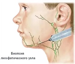 Біопсія лімфатичних вузлів на шиї (лімфовузли)