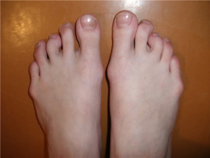 Криві пальці на ногах можливі причини і методи усунення - відповіді і поради на твої
