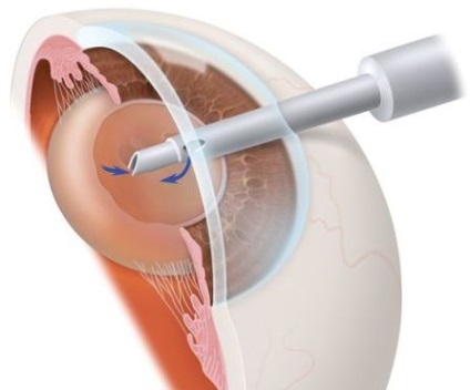 Основні протипоказання до операції на очах при катаракті, про хвороби очей