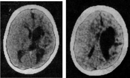 Пороки розвитку головного мозку - комп'ютерна томографія мозку