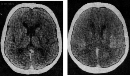 Пороки розвитку головного мозку - комп'ютерна томографія мозку