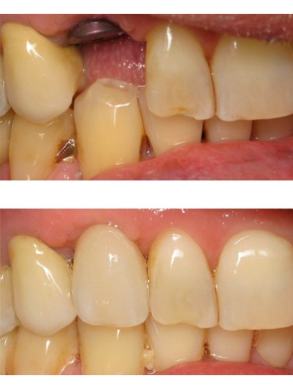 Імплантація зубів види і ціни в москві, зубні імплантати, установка під ключ імплантатів