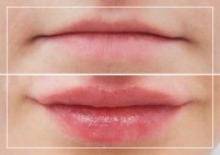 Збільшення і зміна форми губ