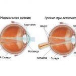 Що таке глаукома, її причини та наслідки, симптоми і лікування у дорослих, виникнення і