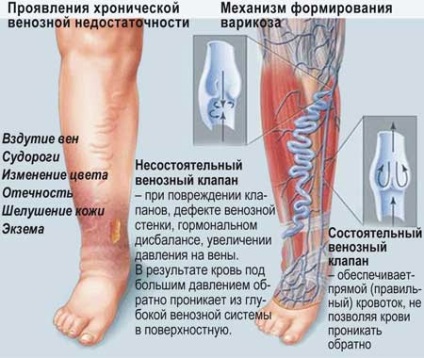 Як лікувати варикоз на ногах у чоловіків в домашніх умовах народними засобами і ліки