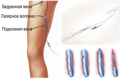 Як лікувати варикоз на ногах у чоловіків в домашніх умовах народними засобами і ліки