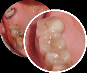 Срібні коронки для зубів ціни в москві - срібні коронки фото і відгуки