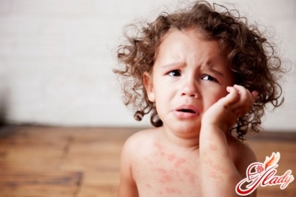 Висип на тілі у дитини фізіологічні та інфекційні висипання, алергія