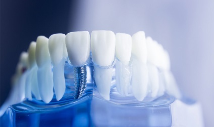 Зубні імпланти протипоказання, відгуки, фото, відео, термін служби, догляд