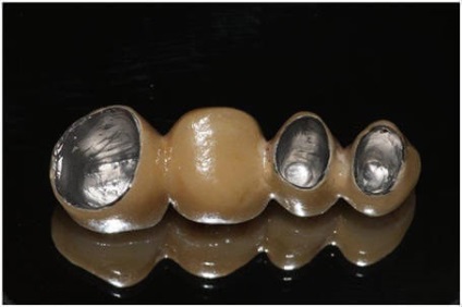 Зубні коронки з коронки зі срібла установка металокераміки зі сплаву срібла, ціни в москві,