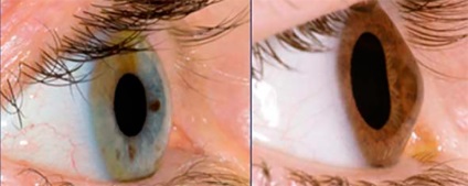 Лікування кератоконуса - центр очної хірургії