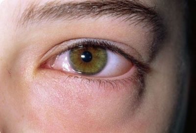 Чому виникає свербіж в очах і як це лікувати