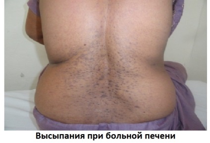 Висипання на шкірі при хворобі печінки ніж лікувати, сайт про методи лікування докторів Неумивакіна,