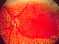 Angiopathy retinális vaszkuláris kezelések, a tünetek, okok