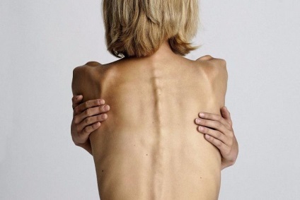 Anorexia tünetek (táblák), az okok anorexia