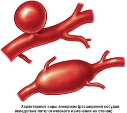 Az aortát expandált (bővülő aorta jelek) Az aortát expandált