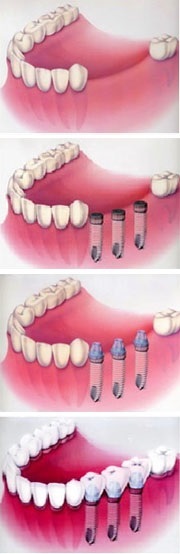 Alacsony fogbeültetés, fogászati implantátumok, implantátum típusok, fogászati (fogtechnikai) Olcsó fogak implantátumok, fogászati implantátumok, implantátum típusok, fogászati
