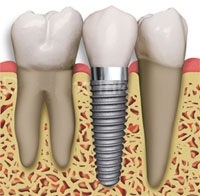 Alacsony fogbeültetés, fogászati implantátumok, implantátum típusok, fogászati (fogtechnikai) Olcsó fogak implantátumok, fogászati implantátumok, implantátum típusok, fogászati
