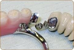 Kapcsos protézis az alsó állkapocs (részleges fogsor) - fotó, vélemények, árak