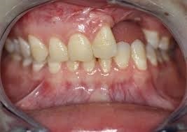 Kapcsos protézis az alsó állkapocs (részleges fogsor) - fotó, vélemények, árak