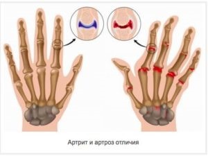 Mi más, mint az osteoarthritis arthritis - Tünetek, okok