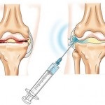 Mi synovitis okok, tünetek, kezelés közös