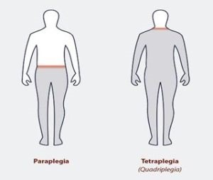 Mi tetraplegia (quadriplegia) kezelésére szindróma okai és prognózis