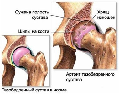 Deformáló arthrosis A csípőízület - Kezelés és okai a betegség