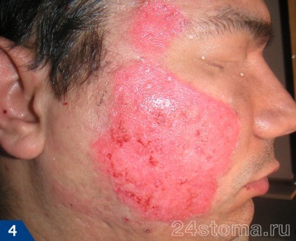 Dermabrasion személy - véleménye, képek előtt és után (utána) Dermabrasion személy - vélemények, fotók előtt és után