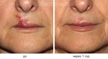 Dermabrasion személy - véleménye, képek előtt és után (utána) Dermabrasion személy - vélemények, fotók előtt és után