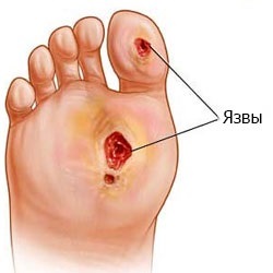kezelés után amputáció toe diabéteszben)