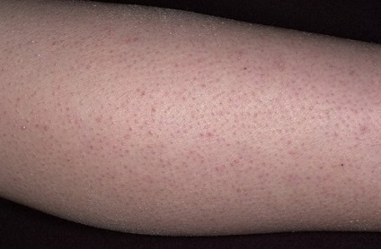 A follikuláris hyperkeratosis a bőr okoz, kezelés