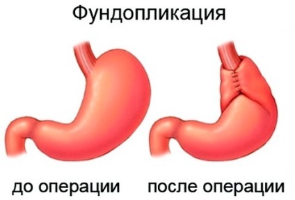 Gastrooesophagealis reflux, hogyan lehet felismerni és kezelni