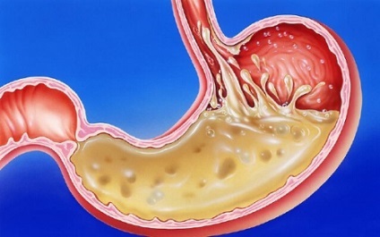 Gastrooesophagealis reflux, hogyan lehet felismerni és kezelni