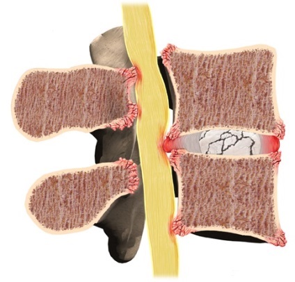 Gastrooesophagealis reflux, hogyan lehet felismerni és kezelni