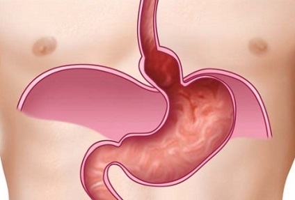 Gastrooesophagealis reflux, hogyan lehet felismerni és kezelni