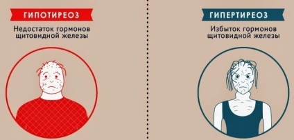 Гіпотиреоз (гіпофункція) щитовидної залози лікування і ксімптоми