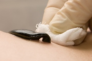 Hirudotherapy nőgyógyászati javallatok és ellenjavallatok, piócák, otthon és az ár (ellenjavallatok) Hirudotherapy nőgyógyászati javallatok és ellenjavallatok, piócák otthon, és az árak