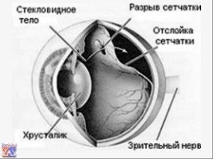 Szem veszélyben, vagy hogy az ilyen szétválasztás a retina (a) Szem veszélyben, vagy hogy az ilyen szétválasztás a retina