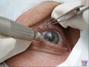 Szem veszélyben, vagy, hogy a retina köteg (köteg) Szem veszélyben, vagy hogy az ilyen szétválasztás a retina